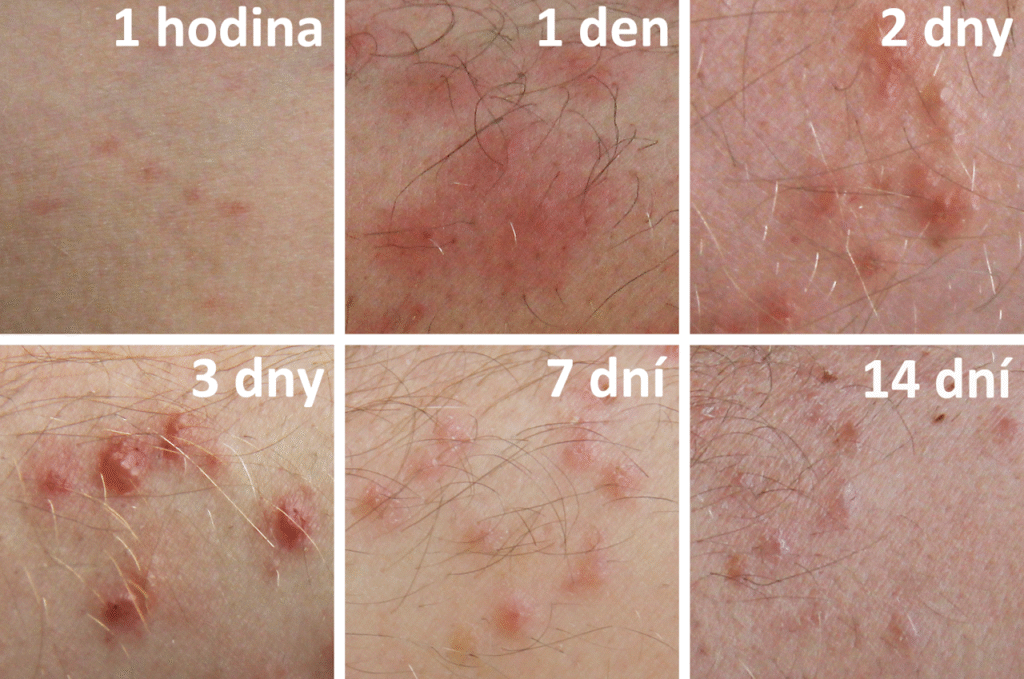 cerkariova dermatitida postupka Bulantova dny