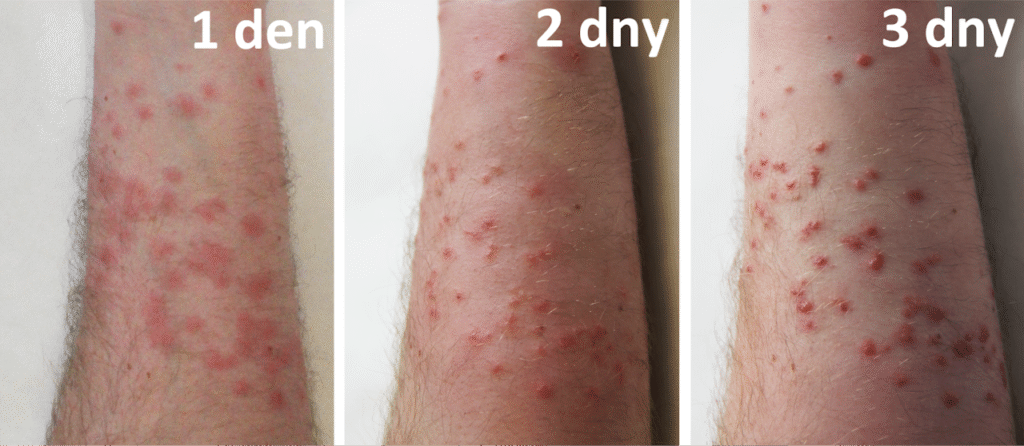 Cerkáriová dermatitida 2 CD postupka ruce 1024x446 1